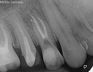 Prvý horný premolár po ošetrení koreňového systému